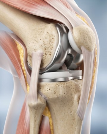 Robotic Knee Replacement in Mumbai